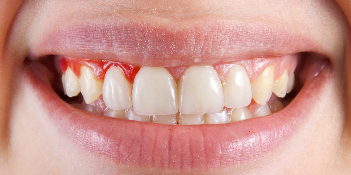 Upala desni – simptomi, uzroci i liječenje krvarenja desni