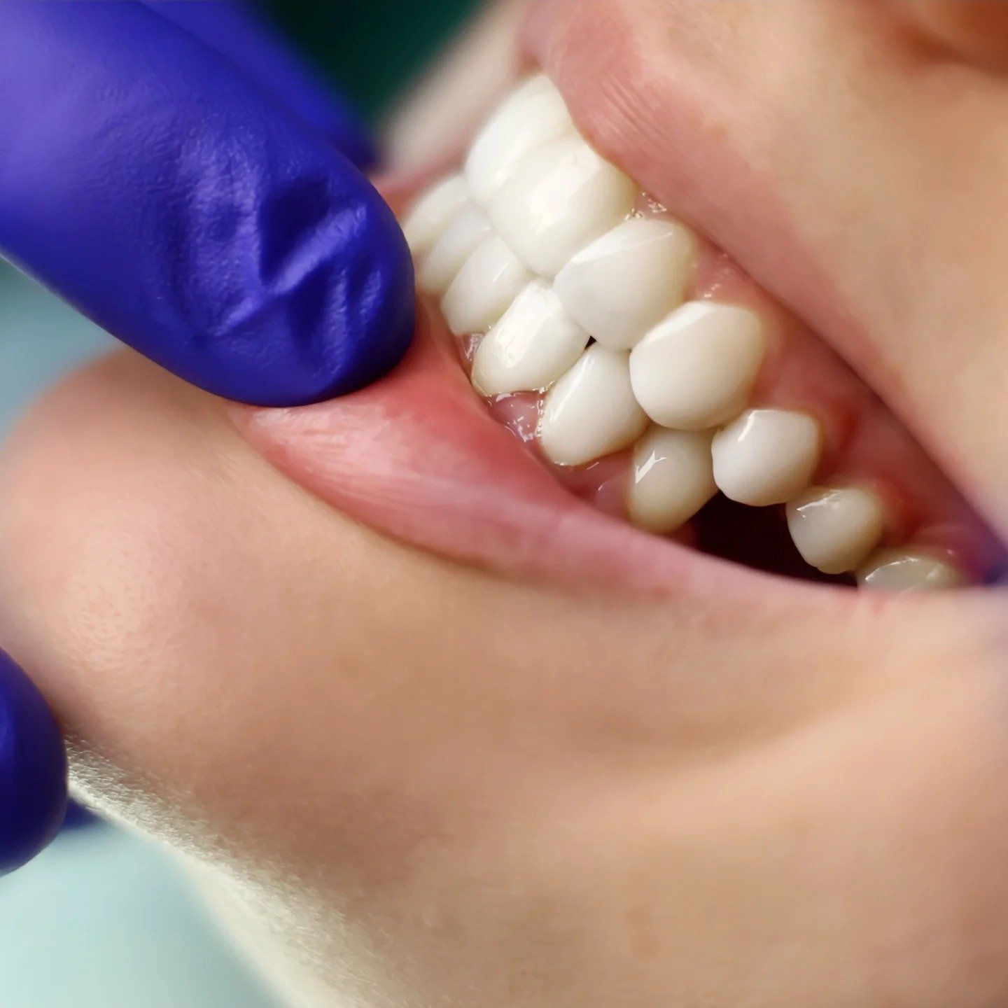 Cirkon-keramičke krunice – cijena, prednosti i trajnost